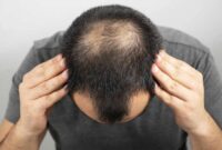 Ilustrasi rambut rontok pada pria | Foto: Ist.