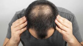 Ilustrasi rambut rontok pada pria | Foto: Ist.