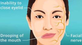 Ilustrasi penyakit Bell’s Palsy | Foto: Ist.