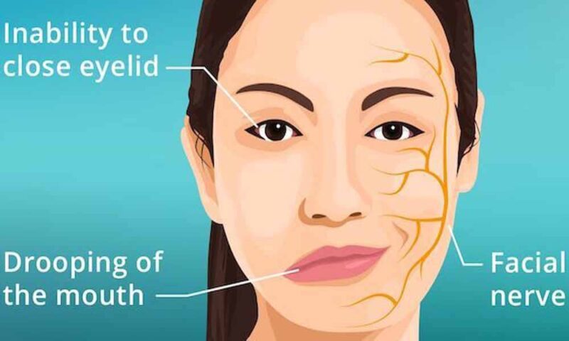 Ilustrasi penyakit Bell’s Palsy | Foto: Ist.