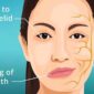 Ilustrasi penyakit Bell’s Palsy | Foto: Ist.
